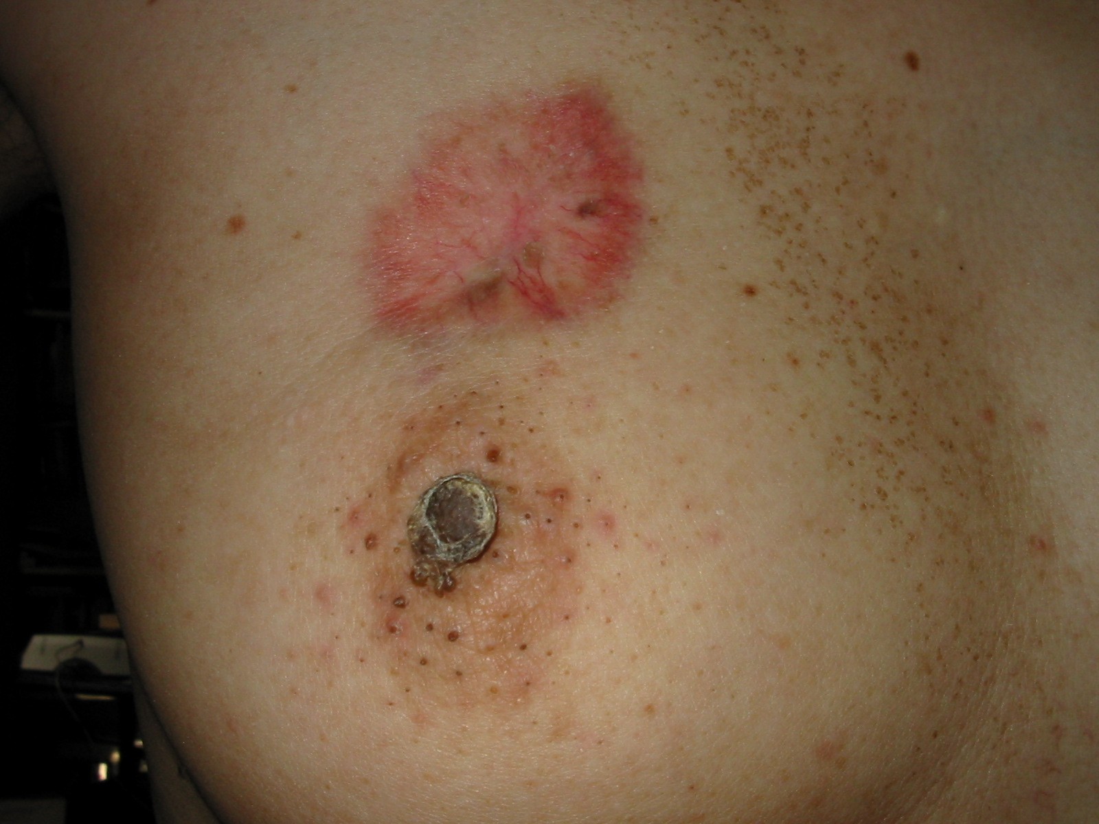 Red Patch On Breast Breastfeeding